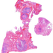 abscessus pulmonia0