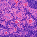 Hashimoto-thyroiditis onkocyta