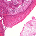 carcinoma cervicis koilocyták