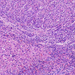 Carcinoma hepatocellulare cirrhotikus és daganatos göb