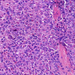 Carcinoma hepatocellulare globulusok