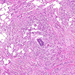 carcinoma lobulare invasivum mammae ductus körül