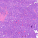 carcinoma papillare thyroideae1