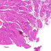 carcinoma transitiocellulare1
