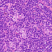 Hodgkin-kór daganatsejtek