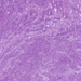 synovialis-sarcoma1