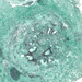 Aspergillosis (grocott) 1