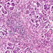 cysticus fibrosis 1