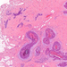 microcalcificatio carcinoma ductale in situ mammae norm jobbra, 